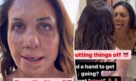 Inspirational Burns Survivor Turia Pitt Reveals Shock Health Scare Daily Mail Online