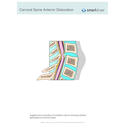 Cervical Spine Anterior Dislocation