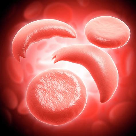 Sickle Shaped Red Blood Cells Hot Sex Picture