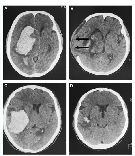 Images From 2 Patients With Right Hypertensive Basal Ganglia Hemorrhage