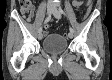 Pelvic Ct Scan Axial And Coronal Sections Ct Scan Of Pelvis In Download
