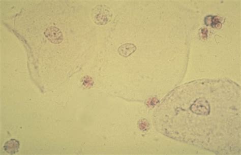 Healthy urine contains a small number of epithelial cells. Urine Studies - Physician Assistant Laboratory Diagnostics ...