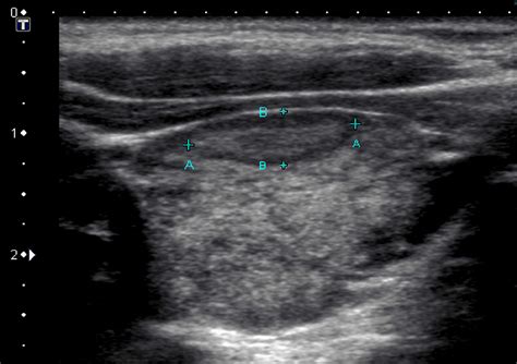 A Few Observations On Thyroid Ultrasound Dr Iain Duncan