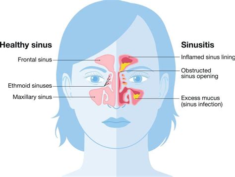Sinusitis Treatment In The Bay Area California Sinus Centers