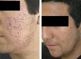 Pictures of Laser Treatment To Remove Scars On Face