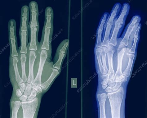 X Ray Of A Healthy Hand Stock Image C0197348 Science Photo Library