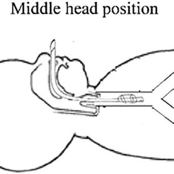 Ideal Depth Of Nasotracheal Tube Placement With A The Cuff Cm Below