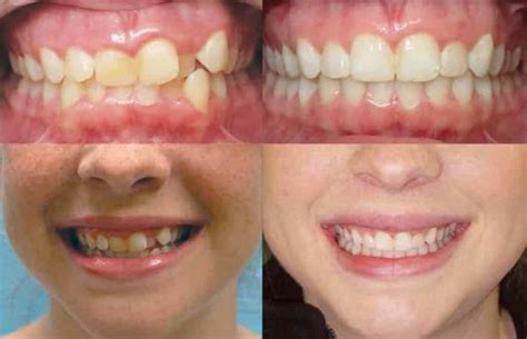 Invisalign Before And After Invisalign Before And After Dentist