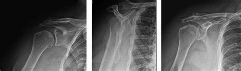 Preoperative Radiographs Of Acromion Fracture Three Views Of The Right