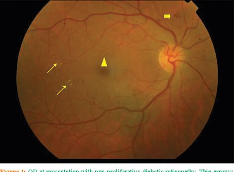 Figure 1 From Diabetic Papillopathy With Macular Edema Treated With