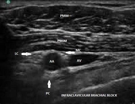 Ultrasound Guided Brachial Plexus Block Anaesthesia Pain And Intensive
