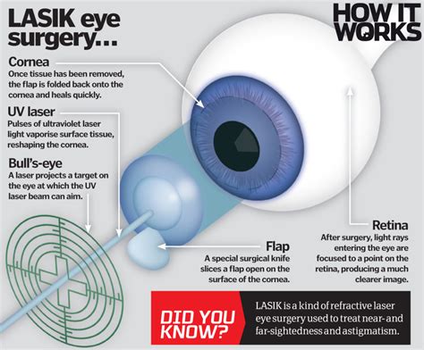 Lasik is a laser assisted keratectomy. How does laser eye surgery work? - How It Works