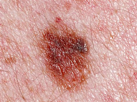Some Ideas On Melanoma Skin Cancer You Should Know Telegraph