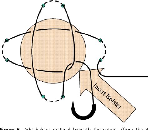 Figure 6 From The Running Bolster Suture For Full Thickness Skin Grafts