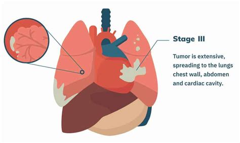 Repeated episodes of pleural effusion can cause pleural thickening to worsen as scar tissue collects. Stage 3 Mesothelioma | Treatment Options and Prognosis