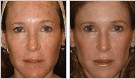 Bbl Kansas City Bbl Laser Skin Treatment Experts Healthylooks