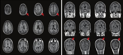Brain Mri Showing Significant Cortical Atrophy In Both Parietal Areas