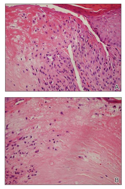 Chondrodermatitis Nodularis Helicis In An Adolescent Boy Not Just For