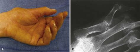 Z Deformity Of Thumb The Rheumatological System Basicmedical Key
