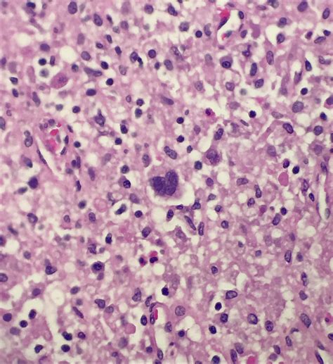 Pathology Outlines Mixed Cellularity Classic Hodgkin Lymphoma
