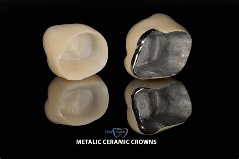 Corone Metallo Ceramica Albania Trio Dental Center