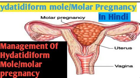 Hydatidiform Mole Ii Molar Pregnancy Ii Management Of Molar