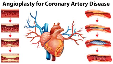 Ct cross sectional anatomy of the thoracic cavity human. Diagram showing angioplasty for coronary artery disease - Download Free Vectors, Clipart ...