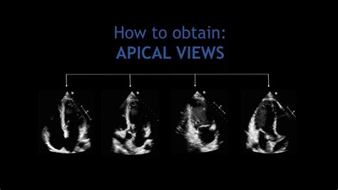 How To Obtain Apical Views Echocardiography Youtube