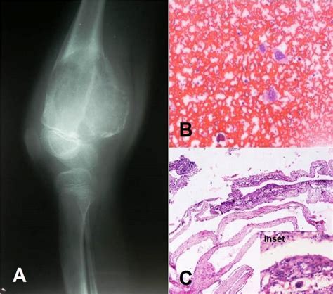 Aneurysmal Bone Cyst A Radiograph Ap View Of Knee Region Showing An