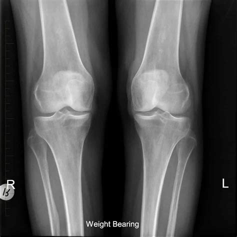 Xray For Knee Pain In Melbourne Melbourne Radiology Clinic