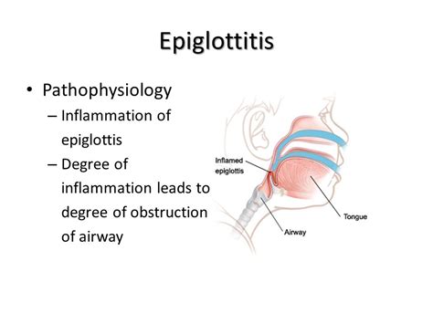 Acute Epiglottitis Antibiotic Treatment