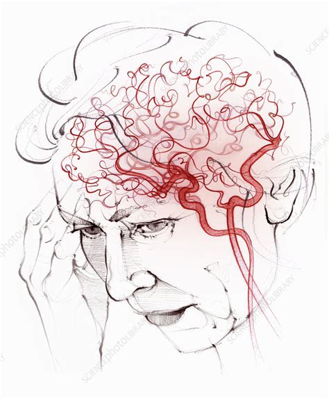 Brain Blood Supply In Vascular Dementia Illustration Stock Image