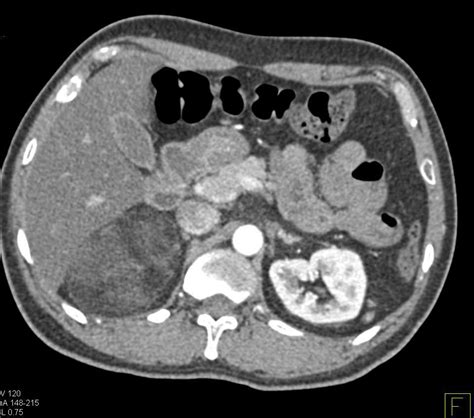 Right Adrenal Myelolipoma Adrenal Case Studies Ctisus Ct Scanning