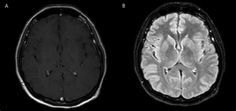 Normal Brain Mri Of The Patient With And Without Contrast Download