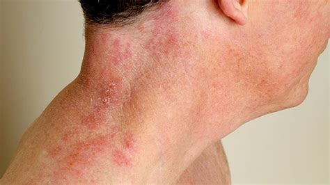 Shingles Signs Symptoms And Complications Everyday Health