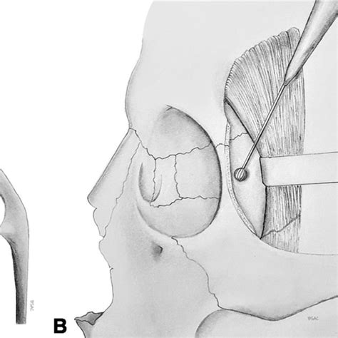 Evolution Of The Incisions Used To Approach The Lateral Wall Of The