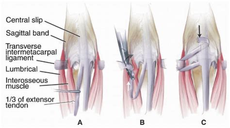 Sagittal Band Rupture Traumatic Extensor Tendon Dislocation