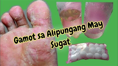 Gamot Sa Alipungang May Sugat Mabilis Gumaling At Matuyo Athletes