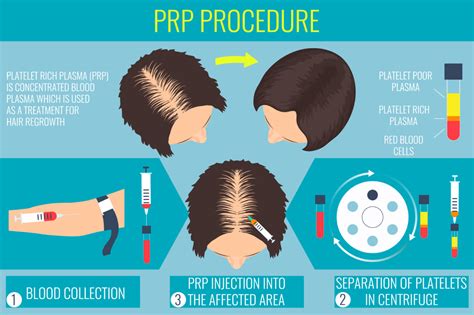 prp therapy for hair loss mollura hair restoration