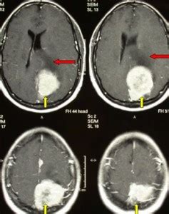 The recovery of this condition depends on the placement of the tumor, the health of the cat and whether it is benign or malignant. Benign Brain Tumors