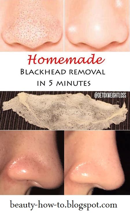Homemade Blackhead Removal In Just 5 Minutes How To Beauty