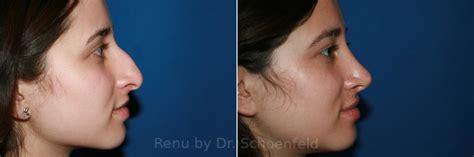 Rhinoplasty Photos Chevy Chase Md Patient 9517