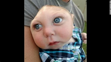 Baby Born Without Skull Defies The Odds