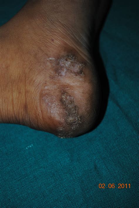 Provocative role in the development of. Tuberculosis, Cutaneous - The Clinical Advisor