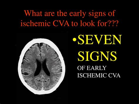 Ppt Ct Head And Ischemic Cva What To Look For On The Early Scan