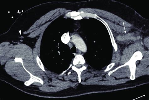 Axial Contrast Enhanced Computed Tomography Ct Of The Chest Showing