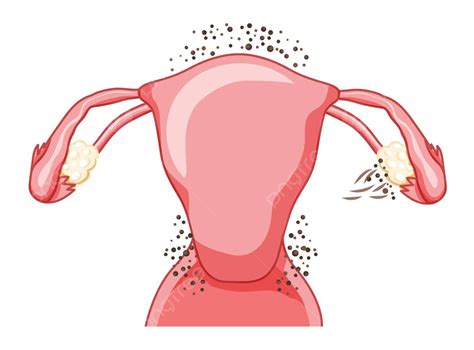 Stadium 1 Endometriosis Sistem Reproduksi Wanita Nyeri Histerektomi