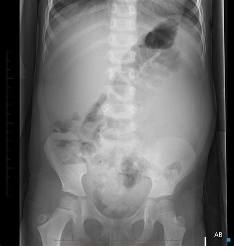 Wilms Tumor X Ray Wikidoc