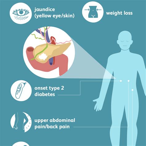 Pancreatic Cancer Signs Symptoms And Complications