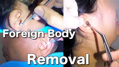 Removal Of Foreign Body Stuck From Peoples Ears Compilation Youtube